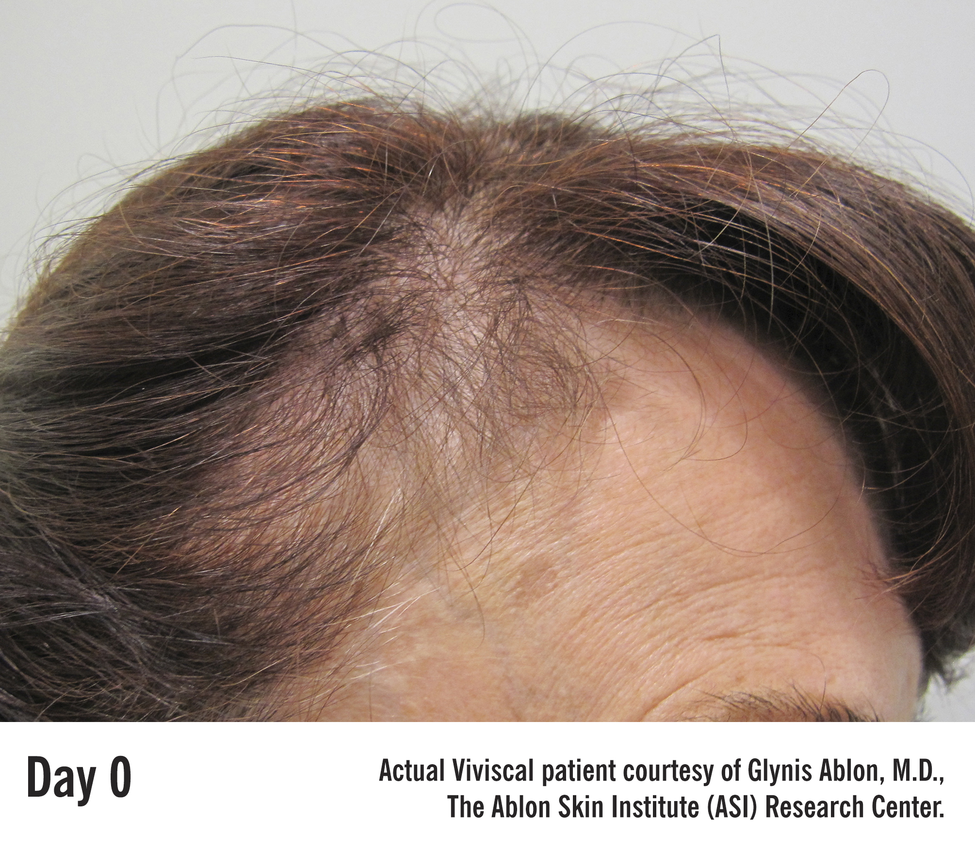 DrAblon April 2015 – Before & After – Patient 2 – Day0