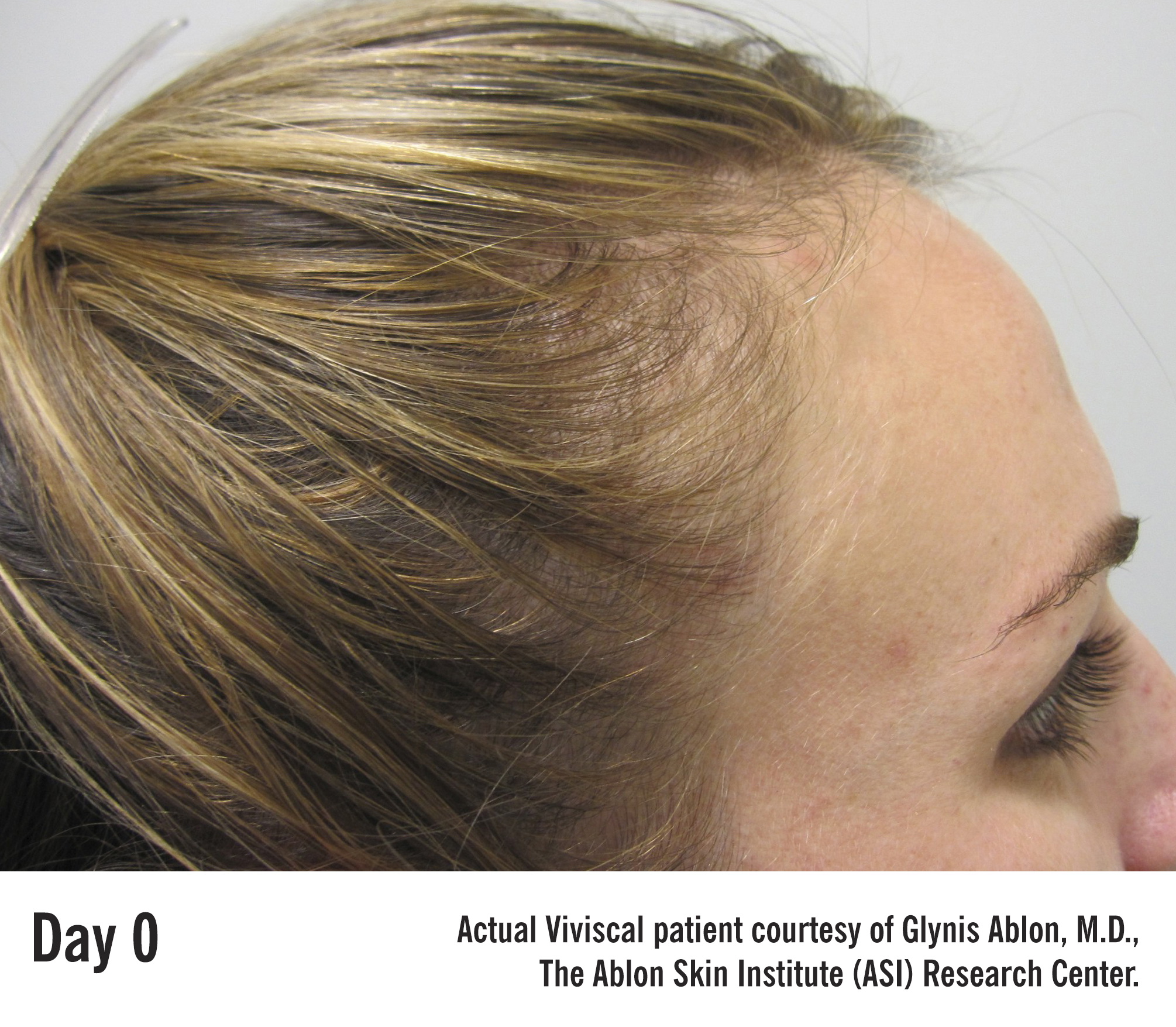 DrAblon April 2015 – Before & After – Patient 4 – Day0